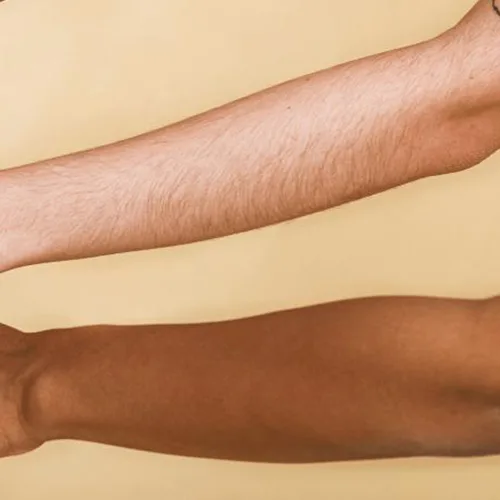 different skin types reacting to sunlight