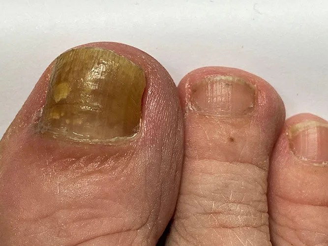 toenail fungus infection symptoms and nail damage