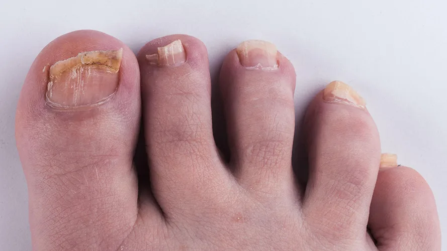 does UV light kill toenail fungus