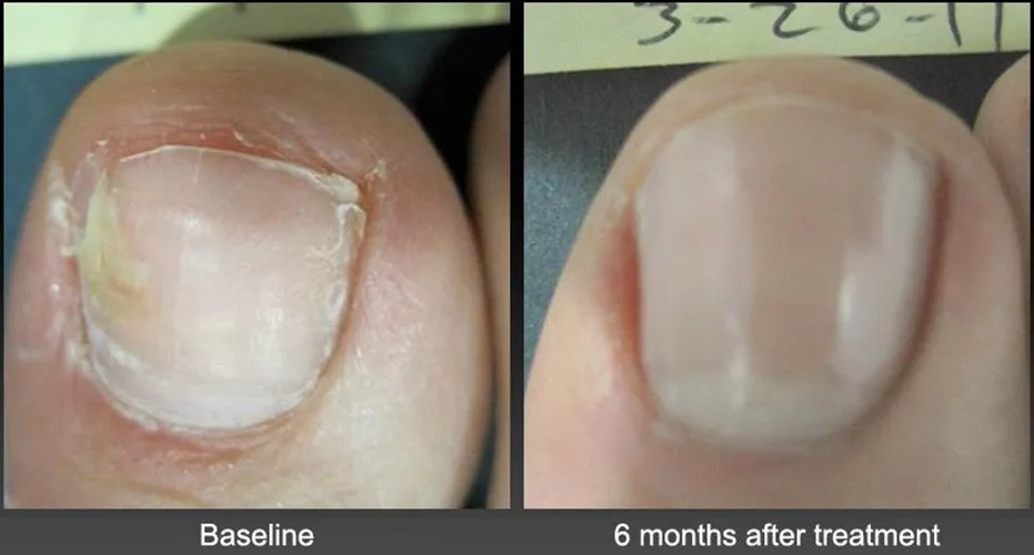 UV light therapy device for toenail fungus treatment