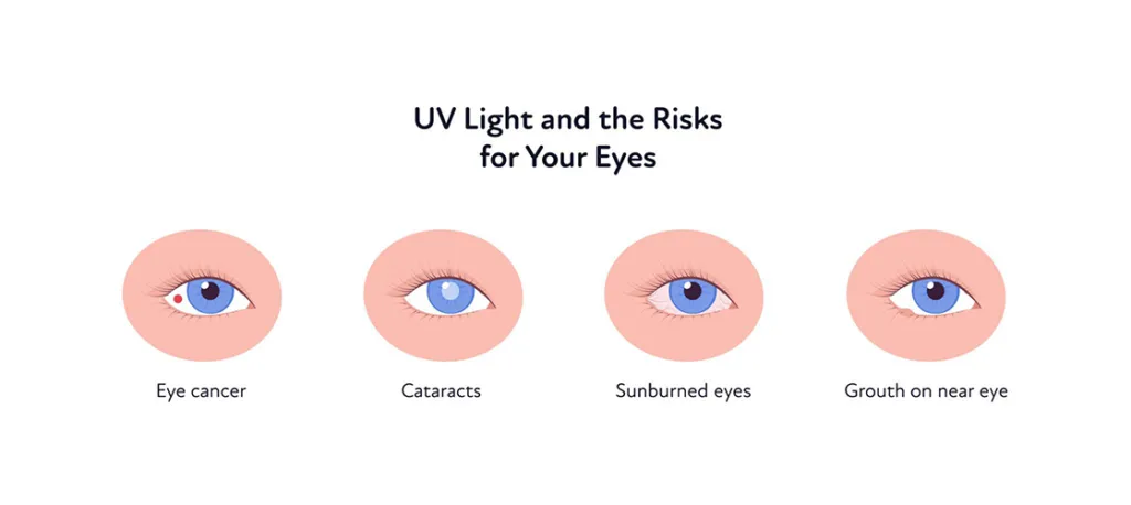 UV radiation affecting different parts of the eye